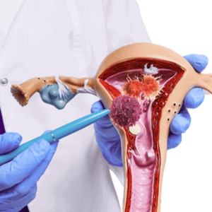 Gynaecological-cancer